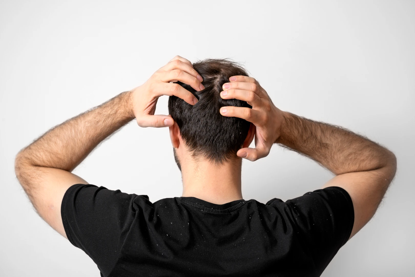 Como acabar com a caspa masculina: causas, tratamentos e cuidados que realmente funcionam